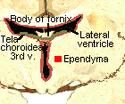 Brain Ventricles: Third Ventricle