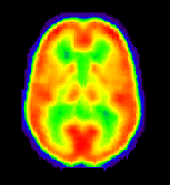 PET brain image