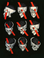 Sabbatini, R.M.E.: The Amazing Case of Phineas Gage