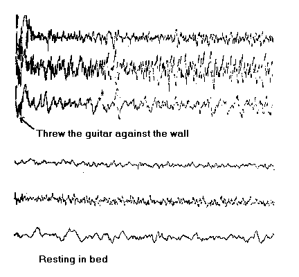 Abnormal EEG tracing