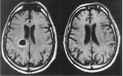 Effect of radiosurgery on brain tumor